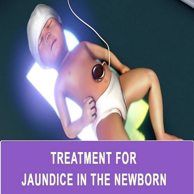 All You Need to Know About Jaundice Treatment for Newborns Image