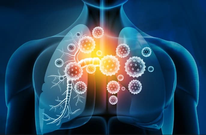 High Flow Nasal Cannula Use in COPD Patients Benefits and Challenges Image