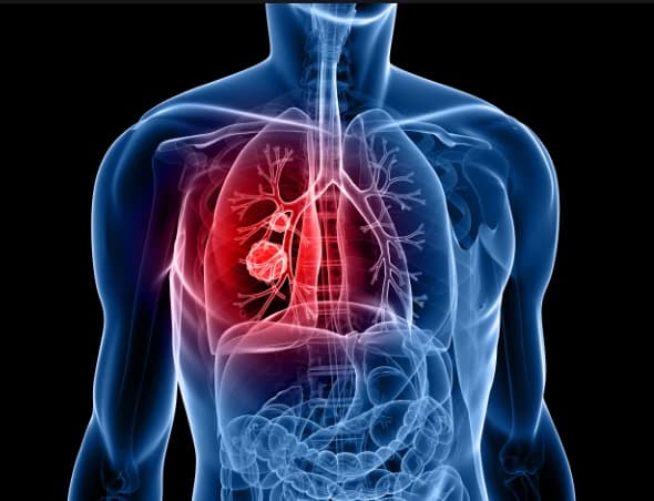 Early Signs of Lung Cancer & The Importance of Early Detection Image